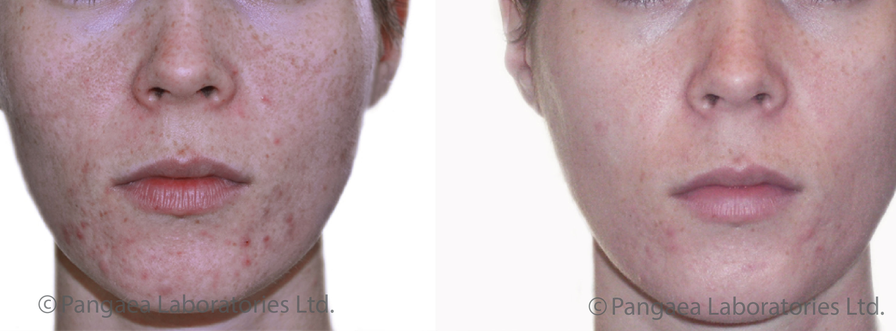 beta peel before and after