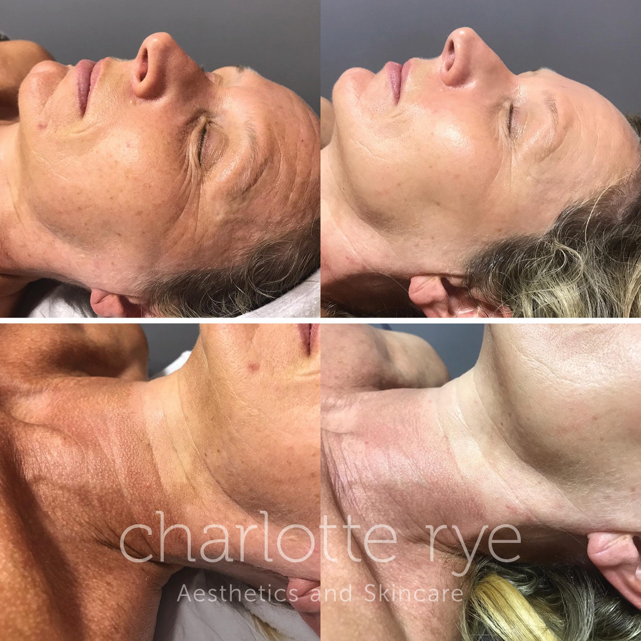 Mesotherapy before and after