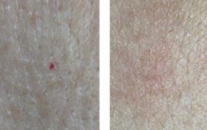 Blood Spot Removal with Advanced Electrolysis