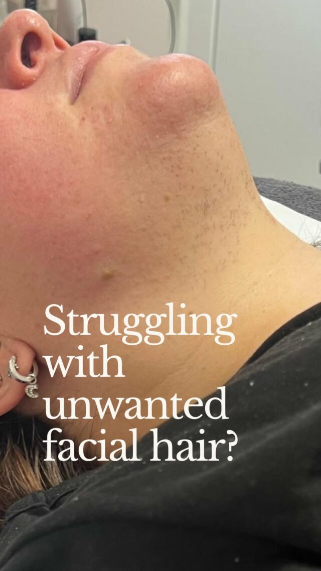 Struggling with unwanted facial hair caused by hormonal changes or imbalances?
It’s a common issue that affects many people throughout life — but what can you do to remove it permanently?Electrolysis is the only FDA- and medically approved method for permanent hair removal.
Unlike temporary fixes like waxing or shaving, electrolysis targets each hair follicle individually, destroying it at the root.Why it works:
Hormonal imbalances can cause thicker, darker facial hair that grows back quickly. Electrolysis works on all hair colours and types and isn’t affected by hormonal shifts — making it a real game-changer for long-term results.How long does it take?
Everyone’s journey is unique, but on average you can expect:• 12–18 months for permanent results
• Weekly or biweekly sessions at first, tapering off as growth reducesCommitment, consistency, and patience are key.DM me if you’re ready to ditch the razor, tweezers, waxing and threading — and take control of your skin!#Electrolysis #ElectrolysisHairRemoval #PermanentHairRemoval #Menopause #PCOS #WomensHealth #HairFree