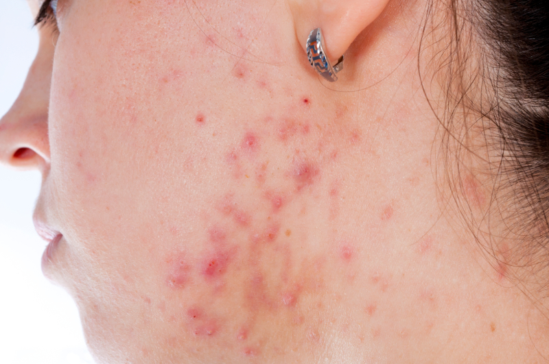inflamed acne